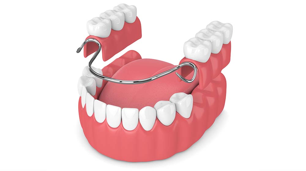 Protesi mobili - Centro Odontoiatrico Oxsana - Dentista Roma - Prenestina