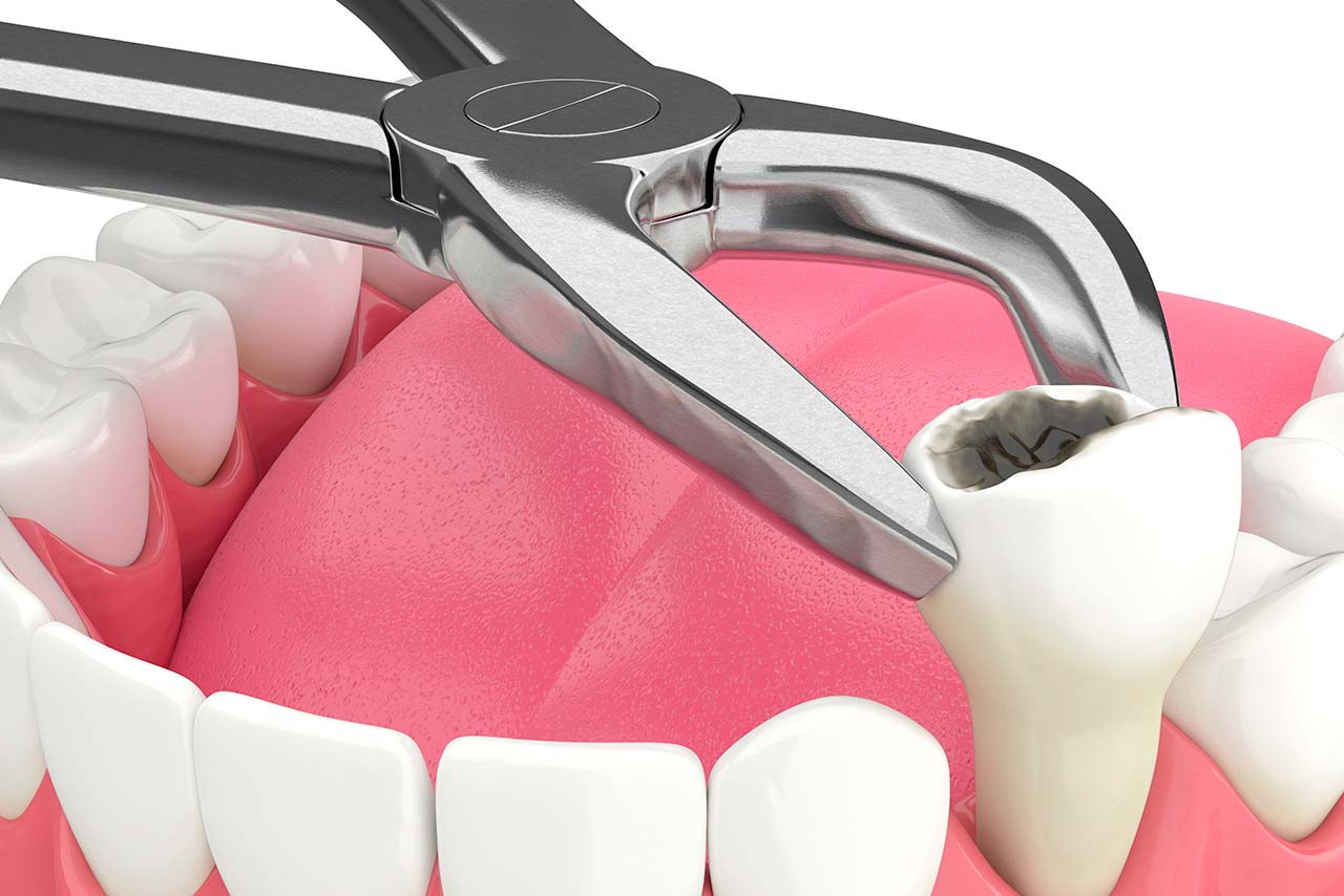 Chirurgia estrattiva - Centro Odontoiatrico Oxsana - Dentista Roma - Prenestina