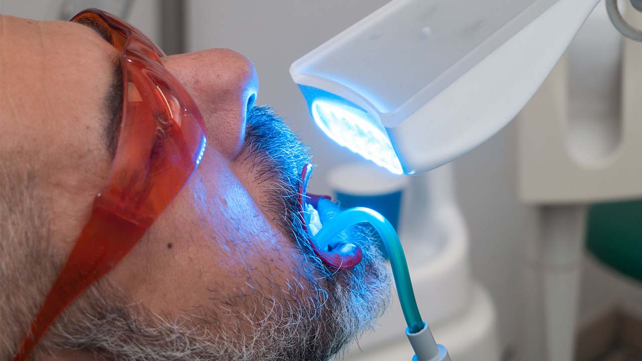 Come funziona lo sbiancamento dentale - Centro Odontoiatrico Oxsana - Dentista Roma - Prenestina