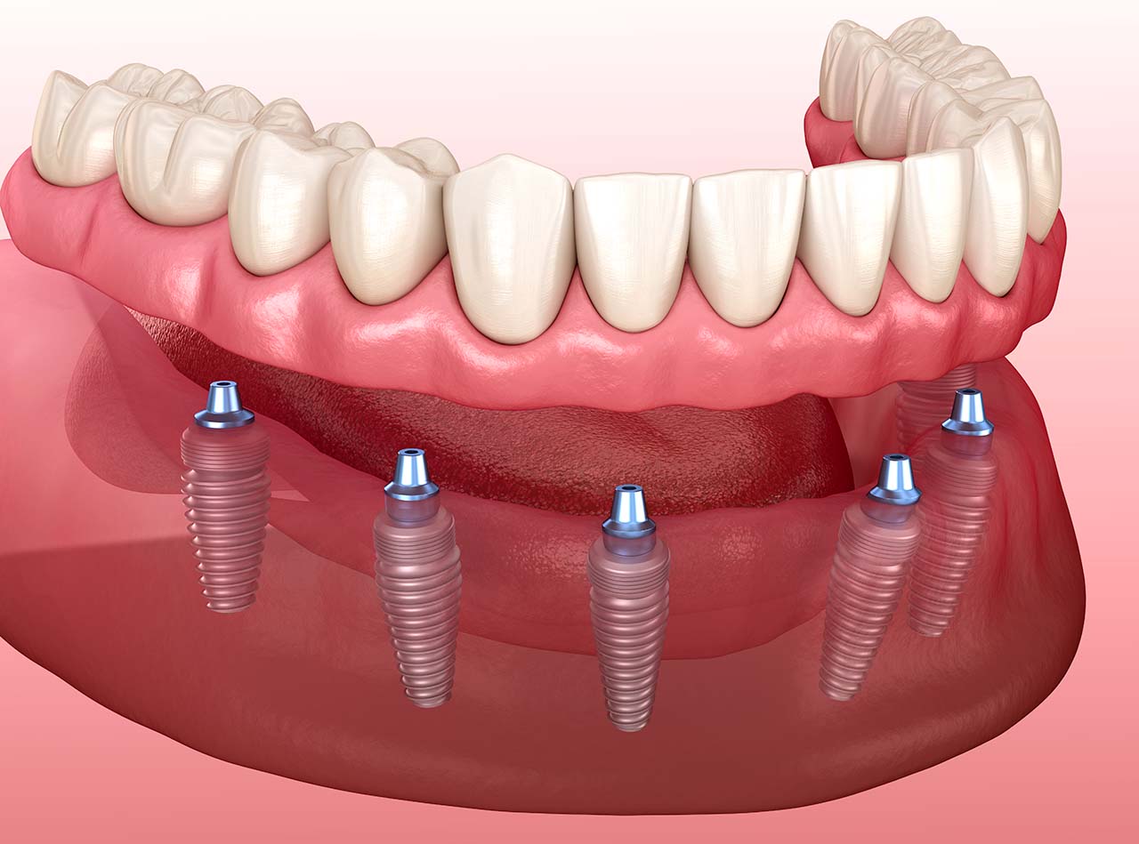 Impianto dentale a carico immediato - Centro Odontoiatrico Oxsana - Dentista Roma - Prenestina
